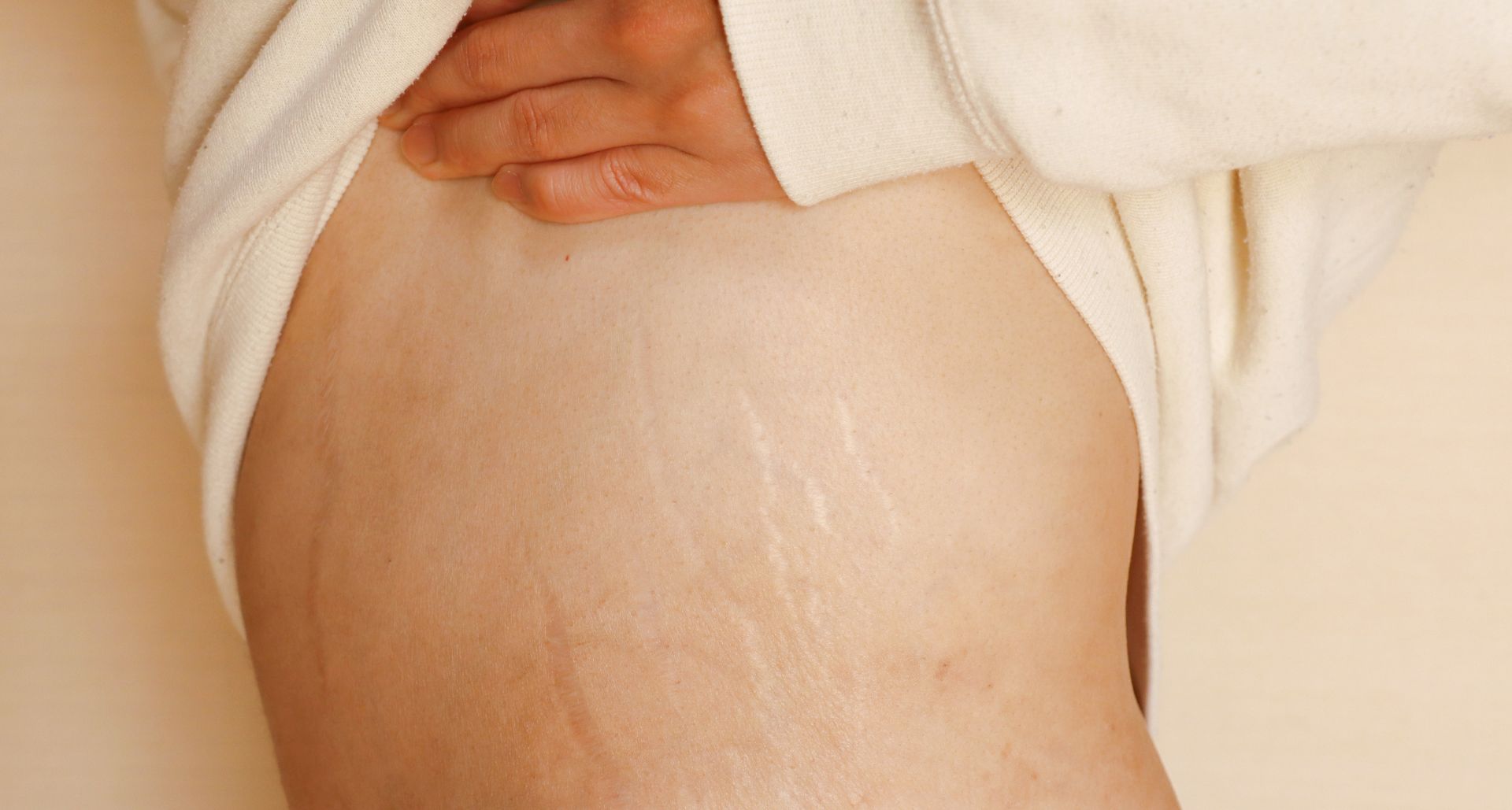 Can you get rid of stretch marks on the back? Causes and treatment